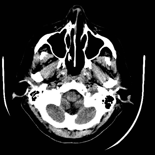 File:Cerebral edema (evolution in time) (Radiopaedia 19418-19440 non-contrast 13).jpg