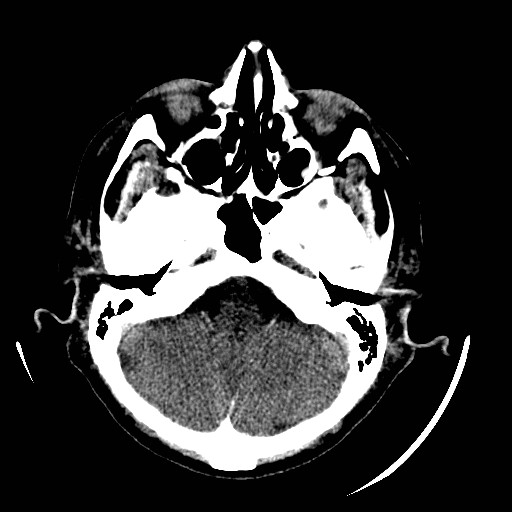 Cerebral edema (evolution in time) (Radiopaedia 19418-19440 non-contrast 24).jpg