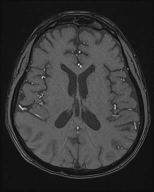 Cerebral embolic infarcts (embolic shower) (Radiopaedia 72391-82921 Axial MRA 111).jpg
