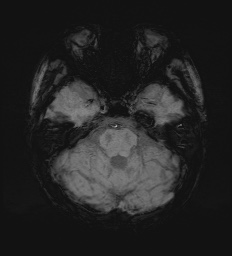 Cerebral embolic infarcts (embolic shower) (Radiopaedia 72391-82921 Axial SWI 22).jpg