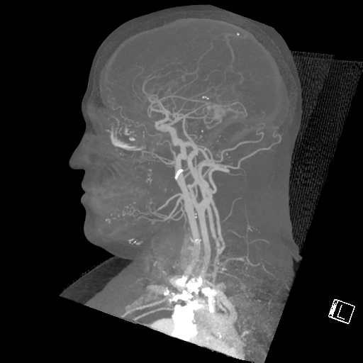 File:Cerebral hemorrhage secondary to arteriovenous malformation (Radiopaedia 33497-34571 A 12).png