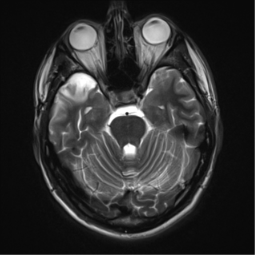 File:Cerebral hemorrhagic contusions- temporal evolution (Radiopaedia 40224-42757 Axial T2 7).png