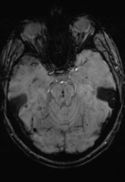 File:Cerebral hemorrhagic contusions- temporal evolution (Radiopaedia 40224-42757 D 13).png