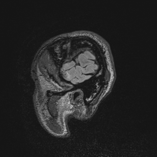 File:Cerebral hemorrhagic contusions- temporal evolution (Radiopaedia 40224-42757 Sagittal T1 73).png