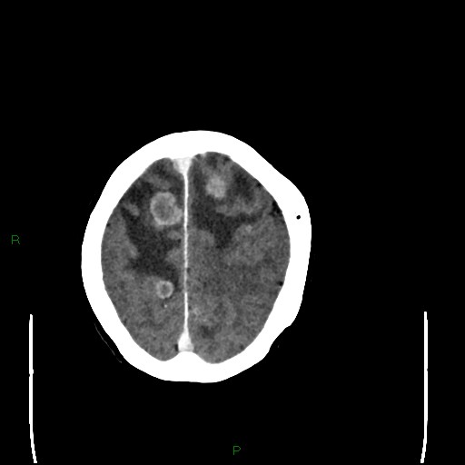 File:Cerebral metastases - breast primary (Radiopaedia 77653-89857 Axial C+ delayed 96).jpg