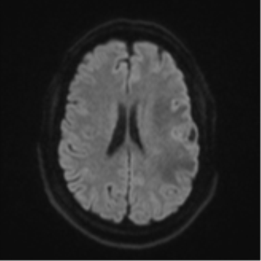 Cerebral metastases mimicking multifocal glioblastoma (Radiopaedia 50843-56353 Axial DWI 45).png