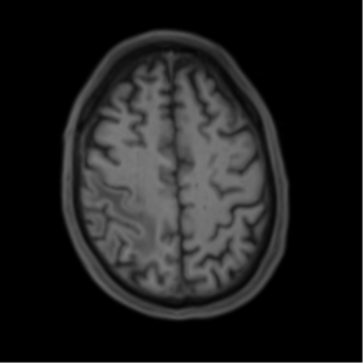 Cerebral metastasis - melanoma (Radiopaedia 54718-60954 Axial T1 41).png