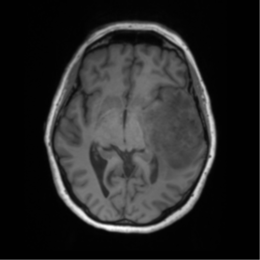 Cerebral metastasis mimicking glioblastoma (Radiopaedia 69155-78937 Axial T1 28).png
