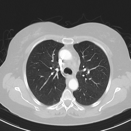File:Cerebral metastasis mimicking glioblastoma (Radiopaedia 69155-78938 Axial lung window 15).png