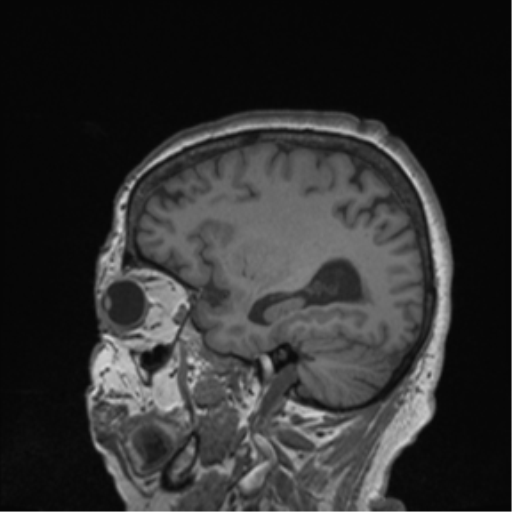 Cerebral metastasis to basal ganglia (Radiopaedia 81568-95413 Sagittal T1 19).png
