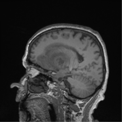 Cerebral metastasis to basal ganglia (Radiopaedia 81568-95413 Sagittal T1 46).png