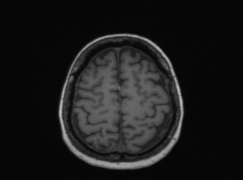 Cerebral ring enhancing lesions - cerebral metastases (Radiopaedia 44922-48817 Axial T1 143).jpg