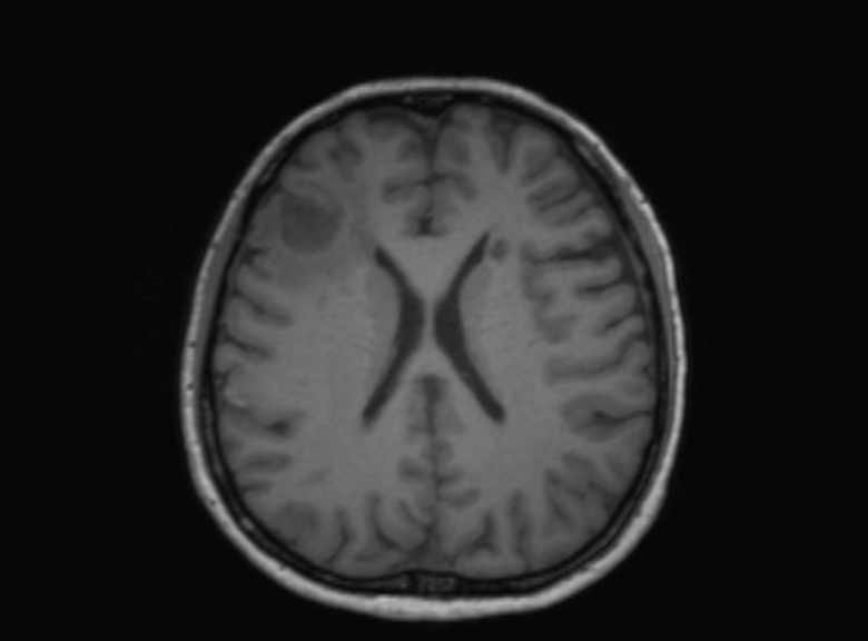 Cerebral ring enhancing lesions - cerebral metastases (Radiopaedia 44922-48817 Axial T1 198).jpg