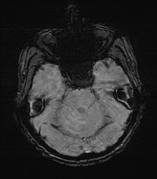 File:Cerebral toxoplasmosis (Radiopaedia 43956-47461 Axial SWI 12).jpg
