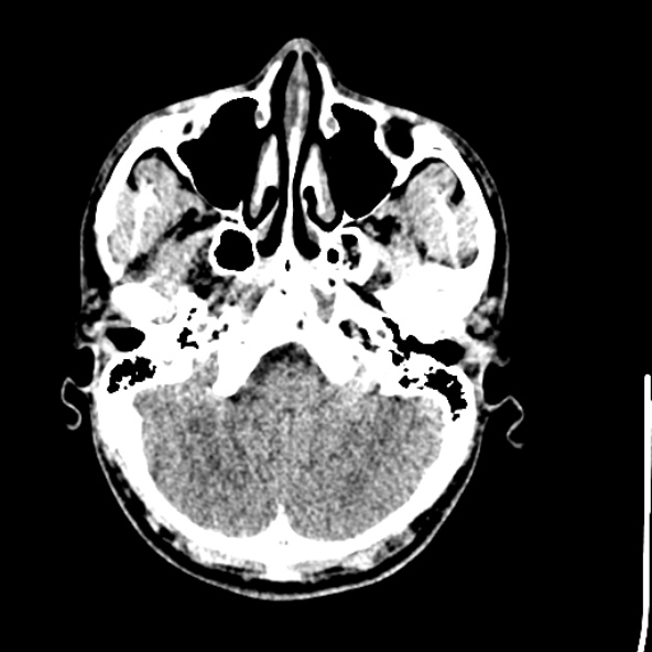 Cerebral toxoplasmosis (Radiopaedia 53993-60131 Axial non-contrast 16).jpg