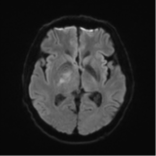 Cerebral toxoplasmosis (Radiopaedia 54575-60804 Axial DWI 49).png