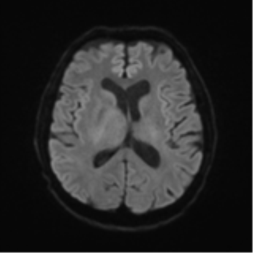 Cerebral toxoplasmosis (Radiopaedia 54575-60804 Axial DWI 51).png