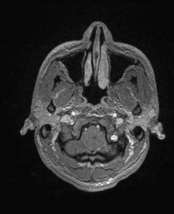 Cerebral toxoplasmosis (Radiopaedia 85779-101597 Axial T1 C+ 18).jpg