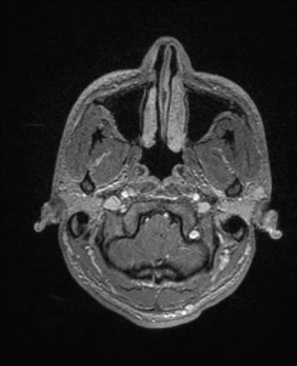 Cerebral toxoplasmosis (Radiopaedia 85779-101597 Axial T1 C+ 19).jpg