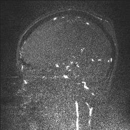 Cerebral tuberculosis with dural sinus invasion (Radiopaedia 60353-68090 Sagittal MRV 58).jpg