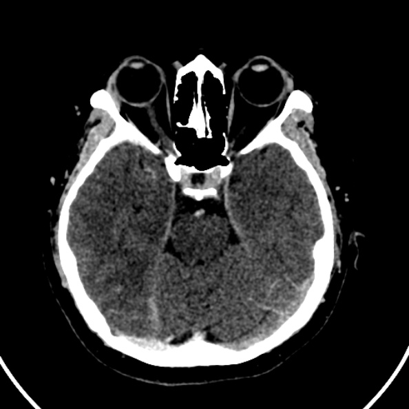 File:Cerebral venous hemorrhagic infarct from venous sinus thrombosis (Radiopaedia 55433-61883 Axial C+ delayed 100).jpg