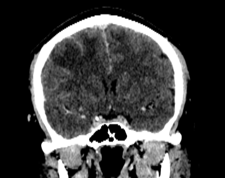 Cerebral venous hemorrhagic infarct from venous sinus thrombosis (Radiopaedia 55433-61883 Coronal C+ delayed 29).jpg