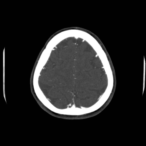 Cerebral venous sinus thrombosis (Radiopaedia 40619-43227 A 194).jpg