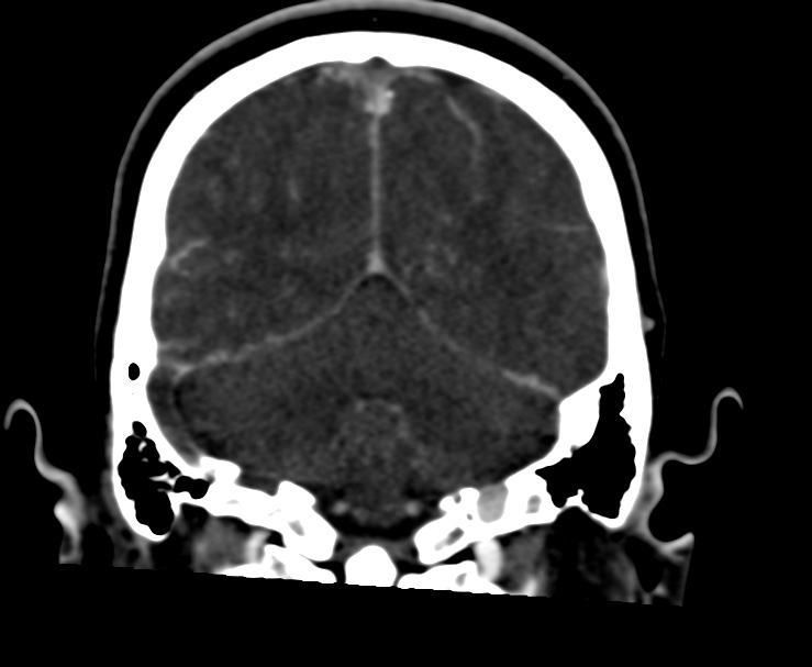 Cerebral venous sinus thrombosis (Radiopaedia 59224-66646 Coronal C+ delayed 56).jpg