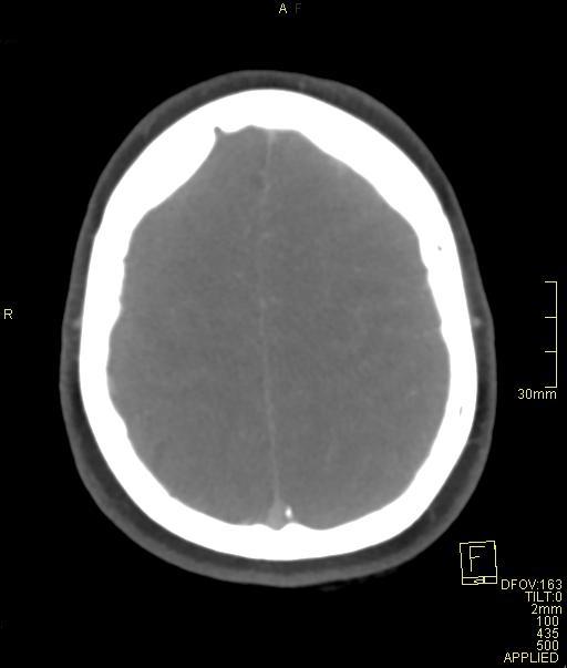 Cerebral venous sinus thrombosis (Radiopaedia 91329-108965 Axial venogram 65).jpg