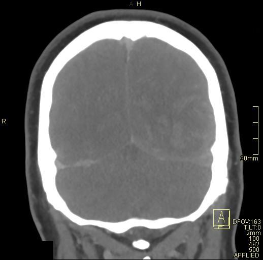 Cerebral venous sinus thrombosis (Radiopaedia 91329-108965 Coronal venogram 72).jpg