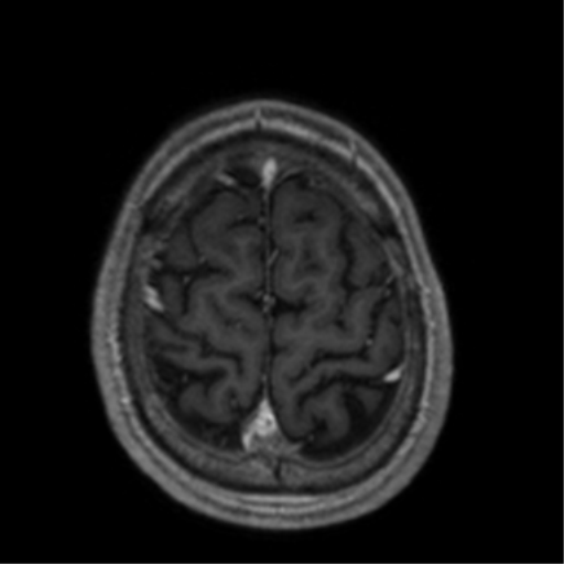 Cerebral venous thrombosis (Radiopaedia 38392-40469 Axial T1 C+ 68).png