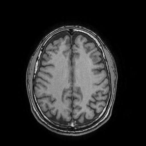 File:Cerebral venous thrombosis with secondary intracranial hypertension (Radiopaedia 89842-106957 Axial T1 119).jpg