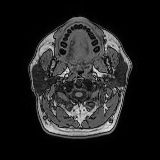 File:Cerebral venous thrombosis with secondary intracranial hypertension (Radiopaedia 89842-106957 Axial T1 17).jpg