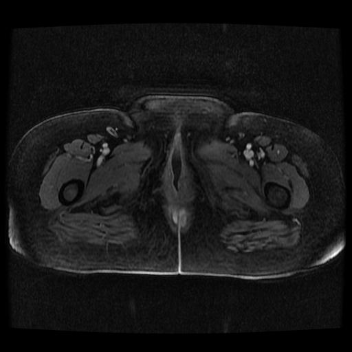 File:Cervical carcinoma (Radiopaedia 70924-81132 Axial T1 C+ fat sat 104).jpg