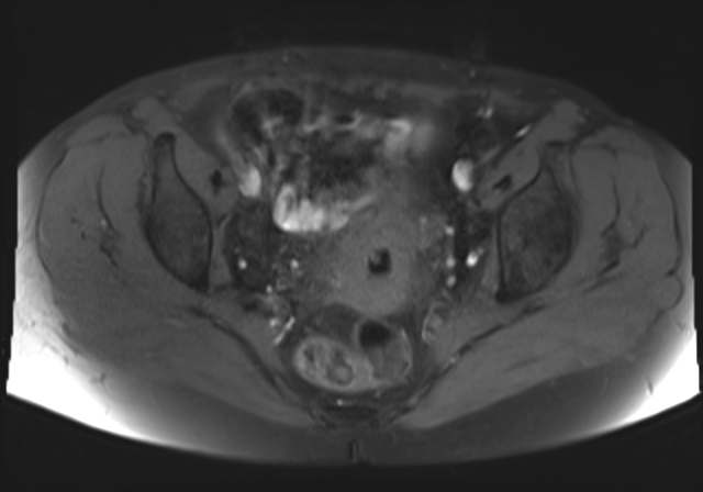 File:Cervical carcinoma (Radiopaedia 88312-104943 Axial T1 fat sat 12).jpg