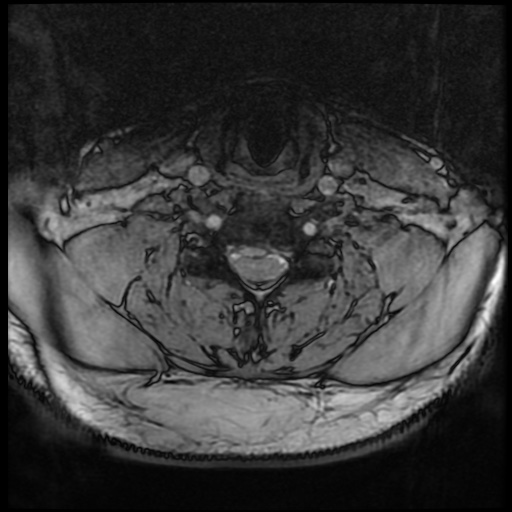 Cervical disc extrusion (Radiopaedia 59074-66364 G 63).jpg