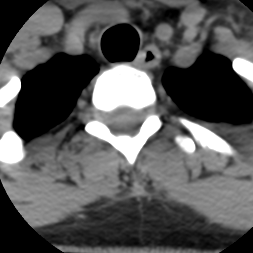 File:Cervical schwannoma (Radiopaedia 57979-64974 Axial non-contrast 62).png
