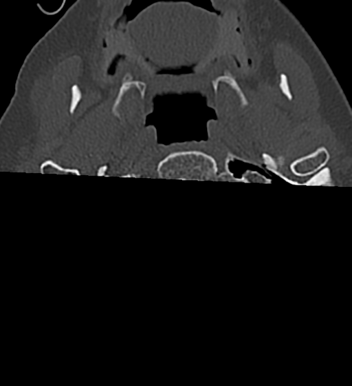 Cervical spine ACDF loosening (Radiopaedia 48998-54070 Axial bone window 2).png