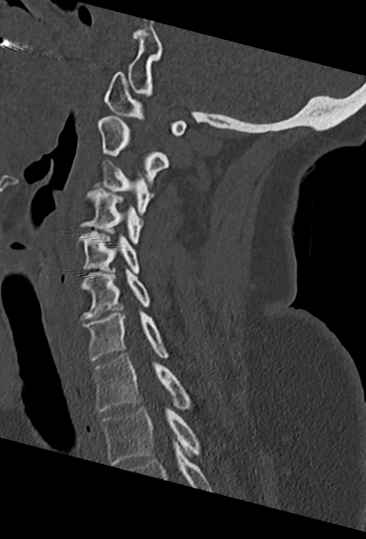 Cervical spine ACDF loosening (Radiopaedia 48998-54070 Sagittal bone window 52).png