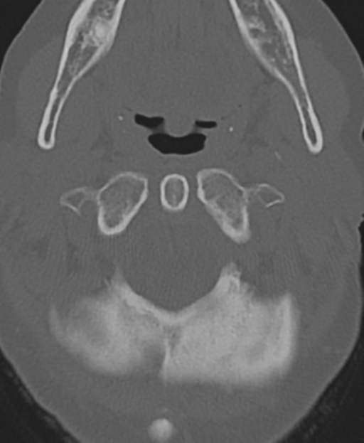 Cervical spine ACDF loosening (Radiopaedia 48998-54071 Axial bone window 14).png