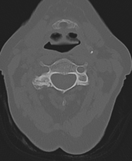 Cervical spine ACDF loosening (Radiopaedia 48998-54071 Axial bone window 24).png