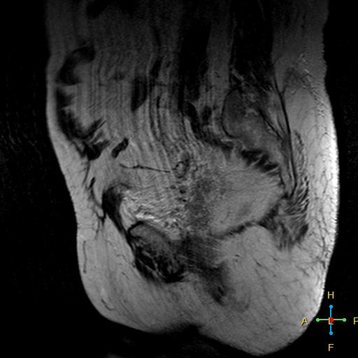 File:Cervical stump squamous cell carcinoma (Radiopaedia 48049-52858 Sagittal T2 4).jpg