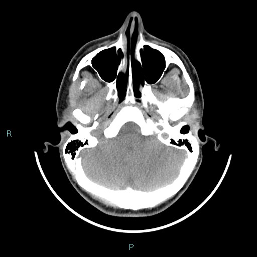 Cervical thymic cyst (Radiopaedia 88632-105335 Axial non-contrast 108).jpg