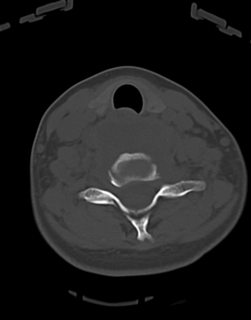 Cervical tuberculous spondylitis (Radiopaedia 39149-41365 Axial bone window 38).png