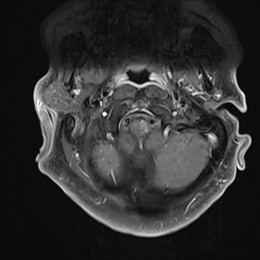 File:Cervical tumor-like myelopathy due to Type V dAVF (Radiopaedia 82461-96604 Axial T1 C+ fat sat 2).jpg