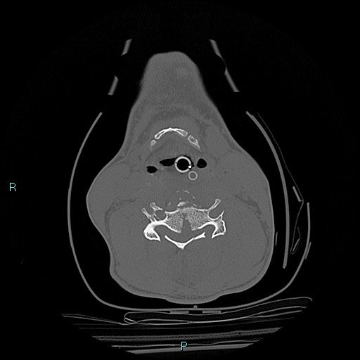 File:Cervical vertebral burst fracture (Radiopaedia 37420-39258 Axial bone window 28).jpg