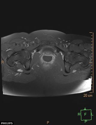 File:Cesarian scar endometriosis (Radiopaedia 68495-78066 Axial T1 C+ fat sat 22).jpg
