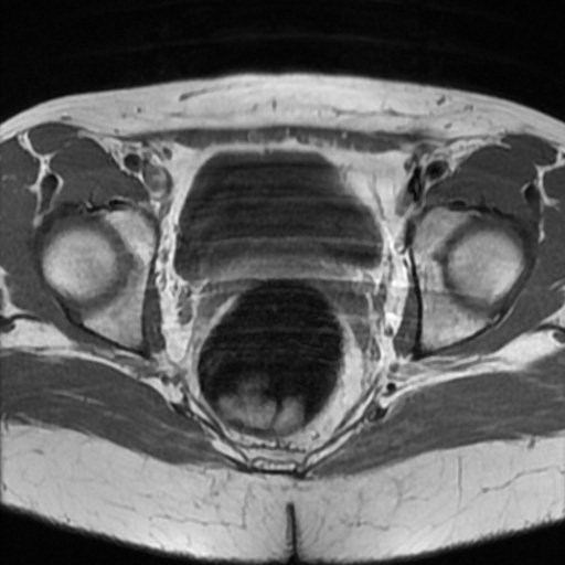 File:Cesarian section scar endometriosis (Radiopaedia 66520-75799 Axial T1 16).jpg