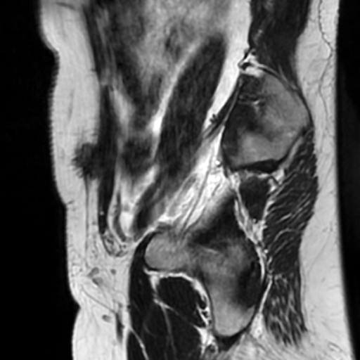File:Cesarian section scar endometriosis (Radiopaedia 66520-75799 Sagittal T2 12).jpg