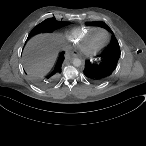 File:Chest multitrauma - aortic injury (Radiopaedia 34708-36147 A 215).png